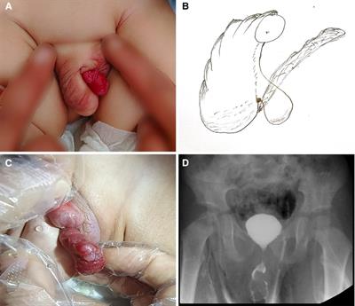 Posterior urethral hamartoma with hypospadias in a child: a case report and literature review